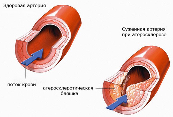 Великое Холестериновое Надувательство. Kрупнейшая афёра XX века