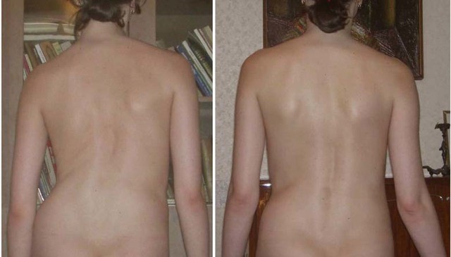 Сколиоз у детей: 12 причин появления, 5 ведущих симптомов, 5 методов лечения Сколиоз у детей: 12 причин появления, 5 ведущих симптомов, 5 методов лечения