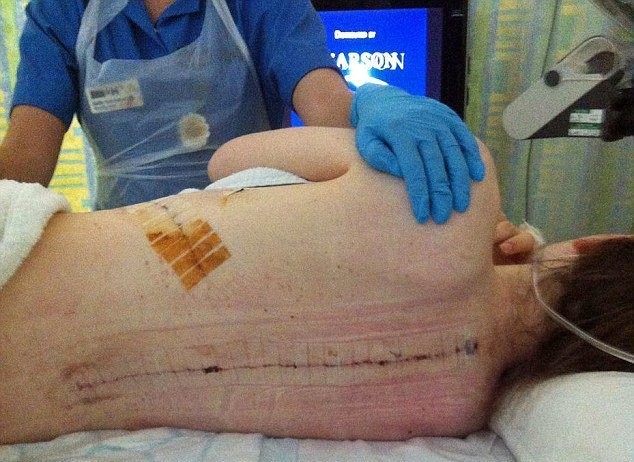 Сколиоз у детей: 12 причин появления, 5 ведущих симптомов, 5 методов лечения Сколиоз у детей: 12 причин появления, 5 ведущих симптомов, 5 методов лечения