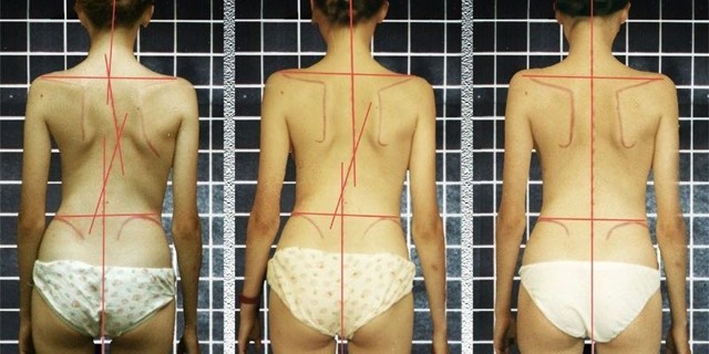 Сколиоз у детей: 12 причин появления, 5 ведущих симптомов, 5 методов лечения Сколиоз у детей: 12 причин появления, 5 ведущих симптомов, 5 методов лечения