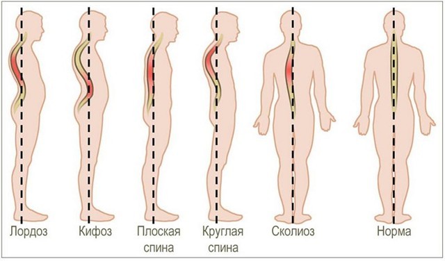 Сколиоз у детей: 12 причин появления, 5 ведущих симптомов, 5 методов лечения Сколиоз у детей: 12 причин появления, 5 ведущих симптомов, 5 методов лечения