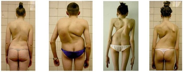 Сколиоз у детей: 12 причин появления, 5 ведущих симптомов, 5 методов лечения Сколиоз у детей: 12 причин появления, 5 ведущих симптомов, 5 методов лечения