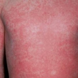 Скарлатина у детей: 3 основных признака, симптомы, диагностика, 8 методов лечения