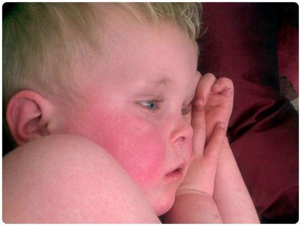 Скарлатина у детей: 3 основных признака, симптомы, диагностика, 8 методов лечения Скарлатина у детей: 3 основных признака, симптомы, диагностика, 8 методов лечения