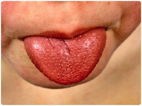 Скарлатина у детей: 3 основных признака, симптомы, диагностика, 8 методов лечения Скарлатина у детей: 3 основных признака, симптомы, диагностика, 8 методов лечения