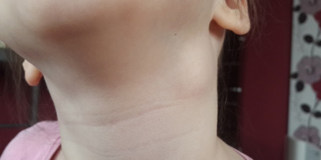 Скарлатина у детей: 3 основных признака, симптомы, диагностика, 8 методов лечения Скарлатина у детей: 3 основных признака, симптомы, диагностика, 8 методов лечения