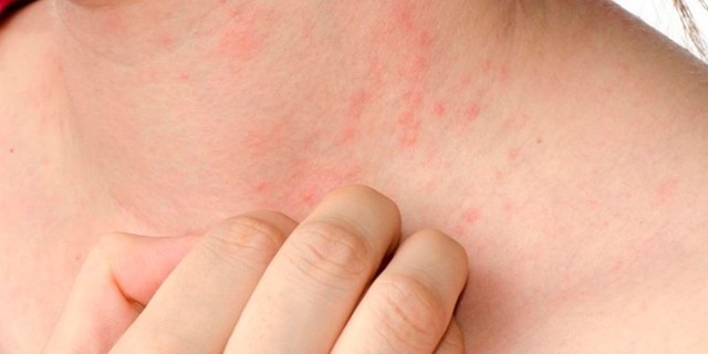 Скарлатина у детей: 3 основных признака, симптомы, диагностика, 8 методов лечения Скарлатина у детей: 3 основных признака, симптомы, диагностика, 8 методов лечения