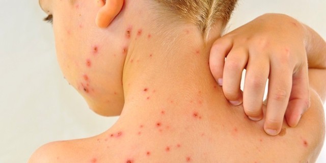 Скарлатина у детей: 3 основных признака, симптомы, диагностика, 8 методов лечения Скарлатина у детей: 3 основных признака, симптомы, диагностика, 8 методов лечения