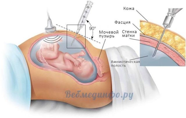 Синдром эдвардса: 10 явных признаков, обзор 3-х методов пренатальной диагностики и врачебной мнение о возможности лечения Синдром эдвардса: 10 явных признаков, обзор 3-х методов пренатальной диагностики и врачебной мнение о возможности лечения