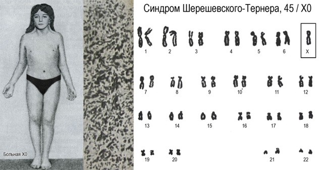 Синдром шерешевского тёрнера : 13 признаков генетического синдрома Синдром шерешевского тёрнера : 13 признаков генетического синдрома