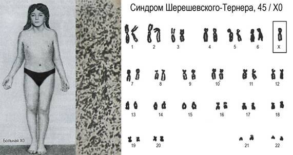 Синдром шерешевского тёрнера : 13 признаков генетического синдрома Синдром шерешевского тёрнера : 13 признаков генетического синдрома