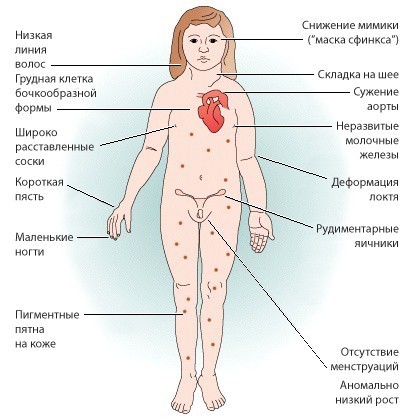 Синдром шерешевского тёрнера : 13 признаков генетического синдрома Синдром шерешевского тёрнера : 13 признаков генетического синдрома