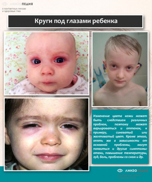 Синяки под глазами у ребенка: 12 возможных причин, методы лечения и профилактики Синяки под глазами у ребенка: 12 возможных причин, методы лечения и профилактики