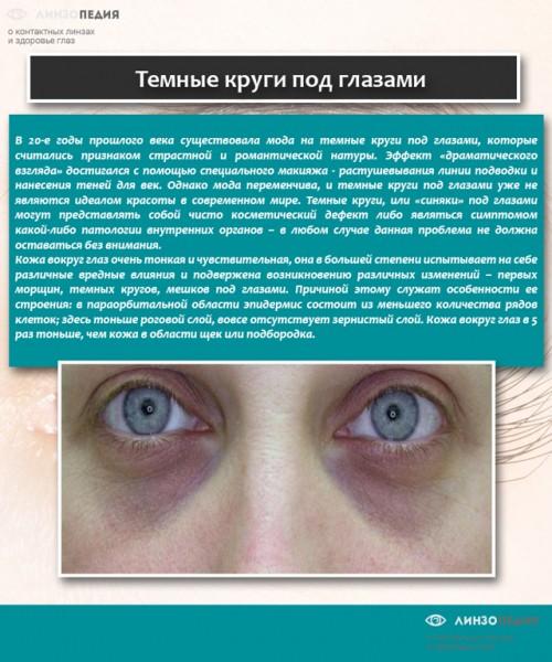 Синяки под глазами у ребенка: 12 возможных причин, методы лечения и профилактики Синяки под глазами у ребенка: 12 возможных причин, методы лечения и профилактики