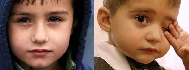 Синяки под глазами у ребенка: 12 возможных причин, методы лечения и профилактики Синяки под глазами у ребенка: 12 возможных причин, методы лечения и профилактики