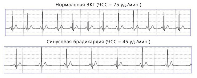 Экг расшифровка у детей: 4 важных показания, норма и отклонения Экг расшифровка у детей: 4 важных показания, норма и отклонения