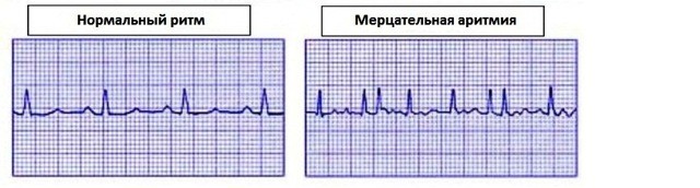 Экг расшифровка у детей: 4 важных показания, норма и отклонения Экг расшифровка у детей: 4 важных показания, норма и отклонения