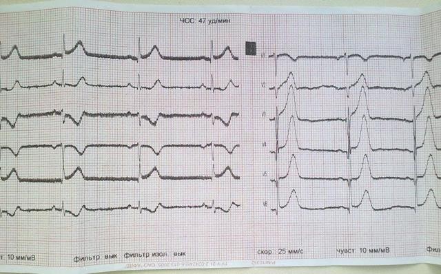 Экг расшифровка у детей: 4 важных показания, норма и отклонения Экг расшифровка у детей: 4 важных показания, норма и отклонения