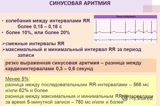 Экг расшифровка у детей: 4 важных показания, норма и отклонения Экг расшифровка у детей: 4 важных показания, норма и отклонения