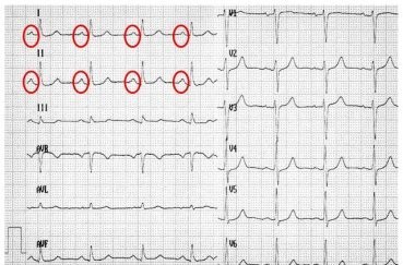 Экг расшифровка у детей: 4 важных показания, норма и отклонения Экг расшифровка у детей: 4 важных показания, норма и отклонения
