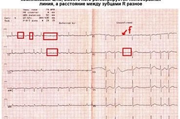 Экг расшифровка у детей: 4 важных показания, норма и отклонения Экг расшифровка у детей: 4 важных показания, норма и отклонения