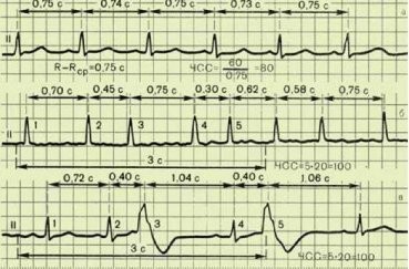 Экг расшифровка у детей: 4 важных показания, норма и отклонения Экг расшифровка у детей: 4 важных показания, норма и отклонения
