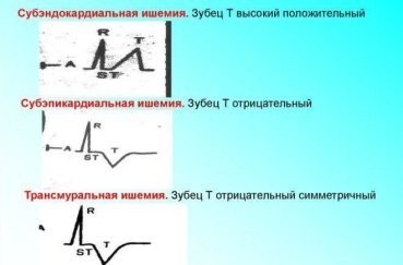 Экг расшифровка у детей: 4 важных показания, норма и отклонения Экг расшифровка у детей: 4 важных показания, норма и отклонения