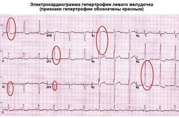 Экг расшифровка у детей: 4 важных показания, норма и отклонения Экг расшифровка у детей: 4 важных показания, норма и отклонения