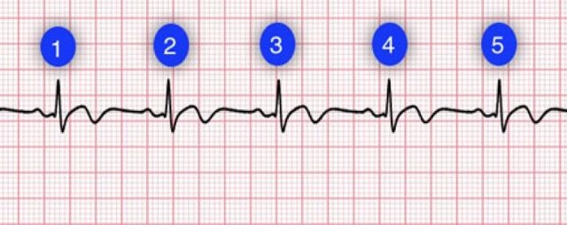 Экг расшифровка у детей: 4 важных показания, норма и отклонения Экг расшифровка у детей: 4 важных показания, норма и отклонения