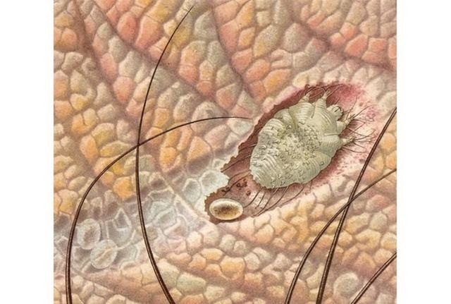 Чесотка у детей: причины, 2 основных формы, 14 принципов лечения, 5 групп препаратов