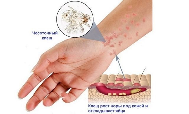 Чесотка у детей: причины, 2 основных формы, 14 принципов лечения, 5 групп препаратов