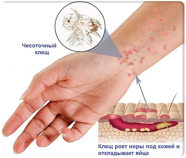 Чесотка у детей: причины, 2 основных формы, 14 принципов лечения, 5 групп препаратов