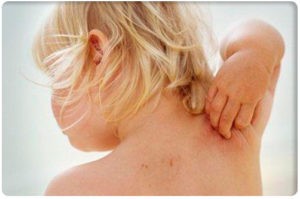 Чесотка у детей: причины, 2 основных формы, 14 принципов лечения, 5 групп препаратов