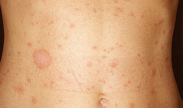 Чем лечить лишай у ребёнка: 6 основных принципов терапии Чем лечить лишай у ребёнка: 6 основных принципов терапии