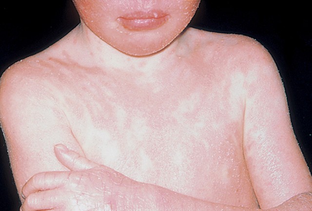 Чем лечить лишай у ребёнка: 6 основных принципов терапии Чем лечить лишай у ребёнка: 6 основных принципов терапии