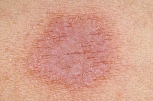 Чем лечить лишай у ребёнка: 6 основных принципов терапии Чем лечить лишай у ребёнка: 6 основных принципов терапии