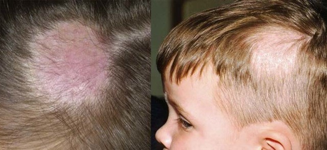 Чем лечить лишай у ребёнка: 6 основных принципов терапии Чем лечить лишай у ребёнка: 6 основных принципов терапии