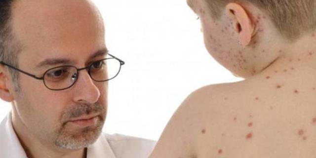 Чем лечить лишай у ребёнка: 6 основных принципов терапии Чем лечить лишай у ребёнка: 6 основных принципов терапии