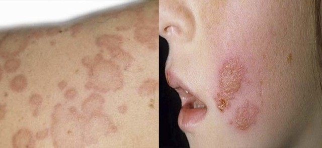 Чем лечить лишай у ребёнка: 6 основных принципов терапии Чем лечить лишай у ребёнка: 6 основных принципов терапии