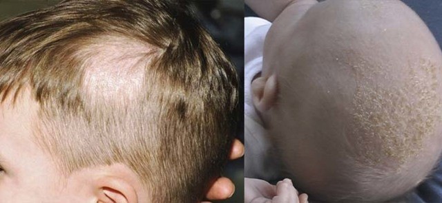 Чем лечить лишай у ребёнка: 6 основных принципов терапии Чем лечить лишай у ребёнка: 6 основных принципов терапии