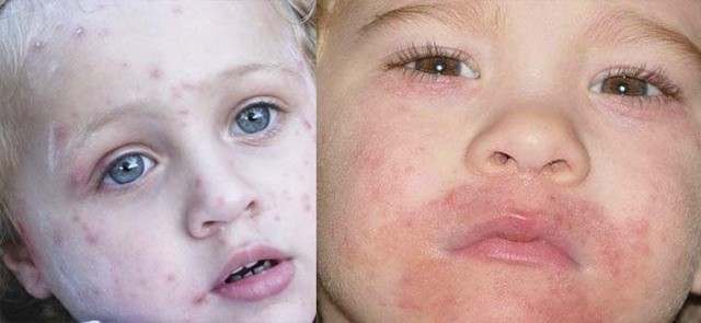 Чем лечить лишай у ребёнка: 6 основных принципов терапии Чем лечить лишай у ребёнка: 6 основных принципов терапии