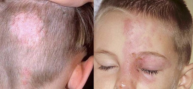 Чем лечить лишай у ребёнка: 6 основных принципов терапии Чем лечить лишай у ребёнка: 6 основных принципов терапии