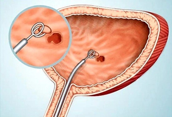 Цистография у детей: 6 показаний и 7 противопоказаний к проведению