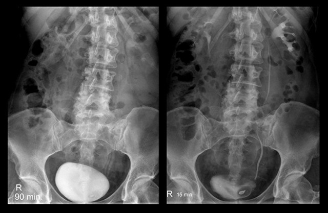Цистография у детей: 6 показаний и 7 противопоказаний к проведению