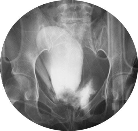 Цистография у детей: 6 показаний и 7 противопоказаний к проведению