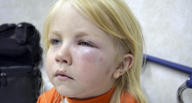 Анафилактический шок у детей: 5 основных причин развития Анафилактический шок у детей: 5 основных причин развития