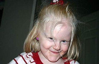 Альбинос: кто такой, 3 типа альбинизма, способы лечения и советы