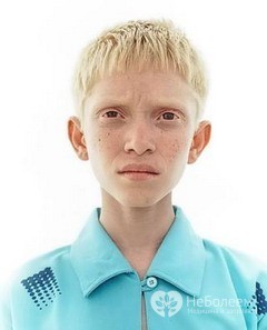 Альбинос: кто такой, 3 типа альбинизма, способы лечения и советы