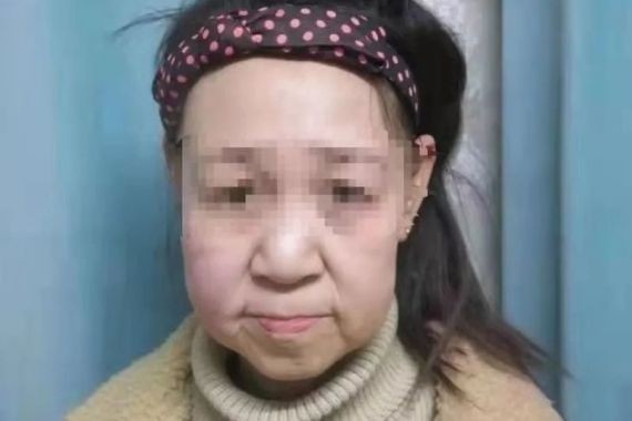 Китайской девочке с лицом старушки пришлось уйти из школы из-за травли