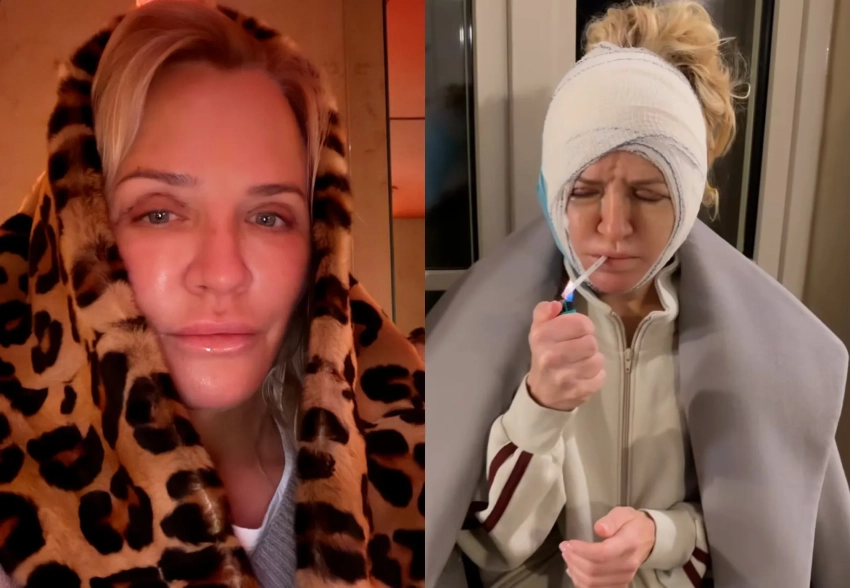 Виктория Шелягова показала, как восстанавливается после пластической операции на лице
